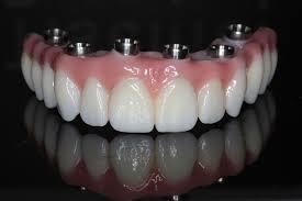 Model of a full set of dentures