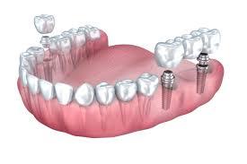 Model showing multiple dental crowns and bridge work