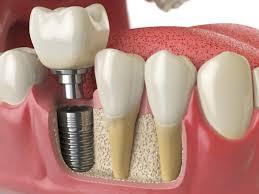 3D model of a dental implant beneath a natural-looking crown